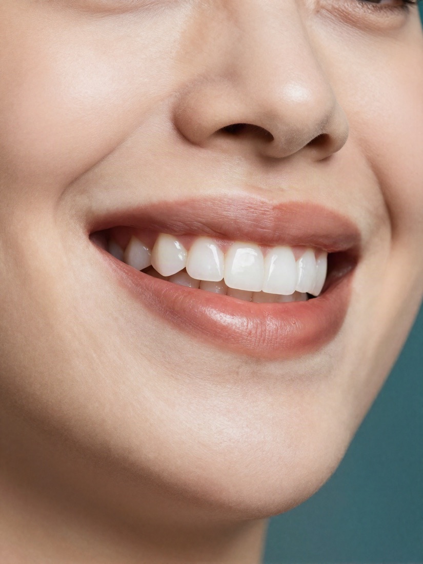 Close-up of a natural smile with porcelain veneers